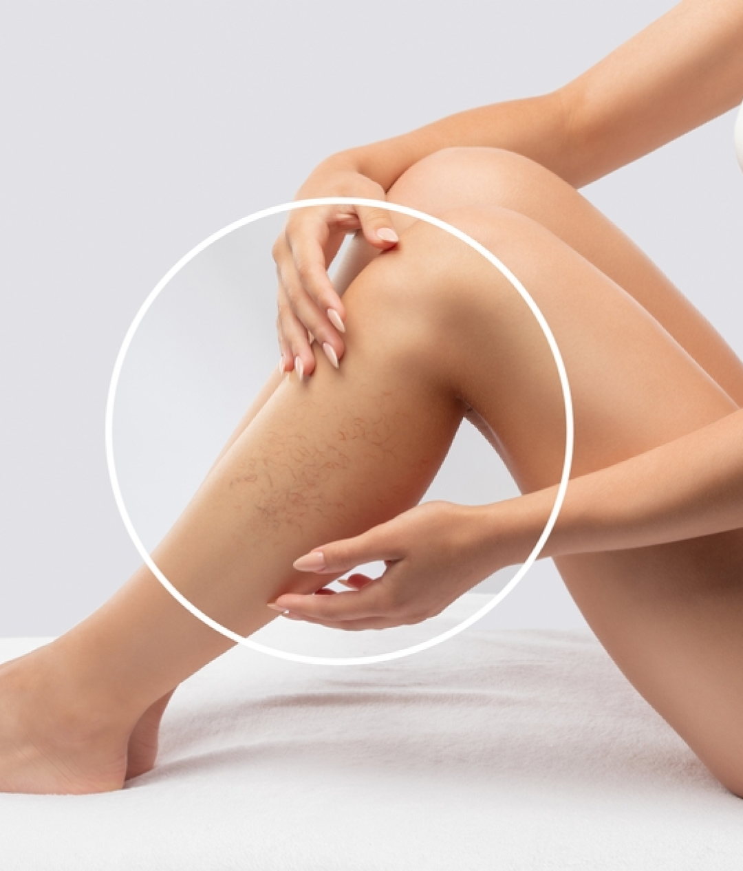 Thread Vein Removal